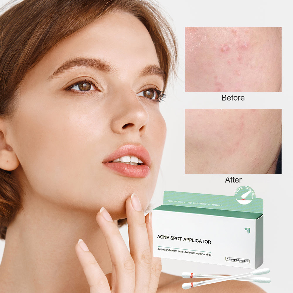 Salicylic Acid Acne Removing To Lighten Marks