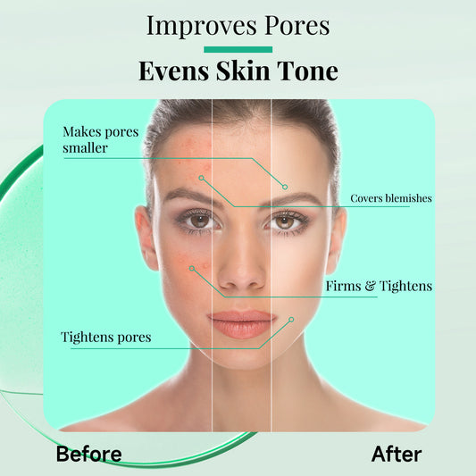 Tea Tree Removing Acne Liquid Female Desalination