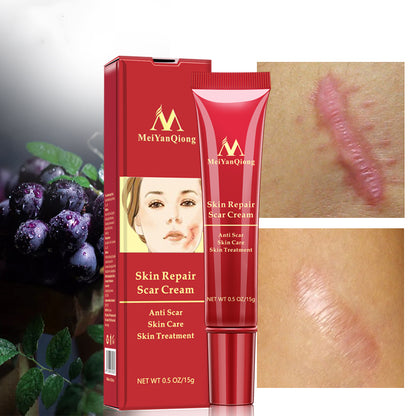Acne scar removal cream
