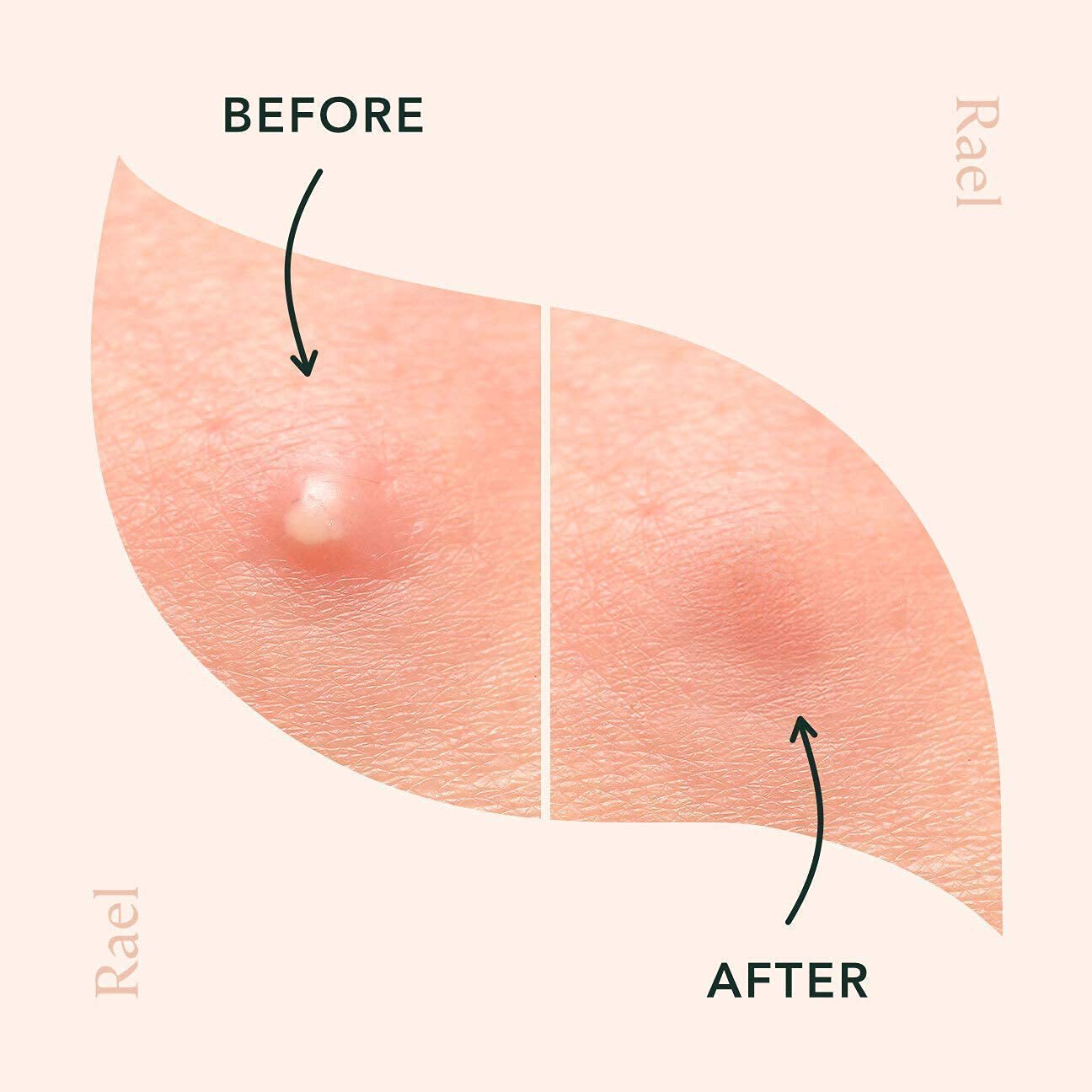 IBeaLee Tea Tree Oil Acne Patches Invisible Makeup Clear Skin