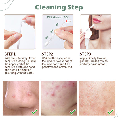 Salicylic Acid Acne Removing To Lighten Marks