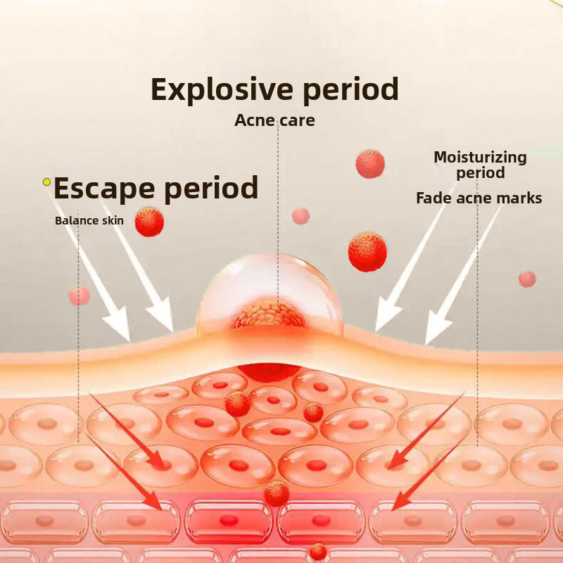 Anti-acne Care Solution To Remove Closed Acne