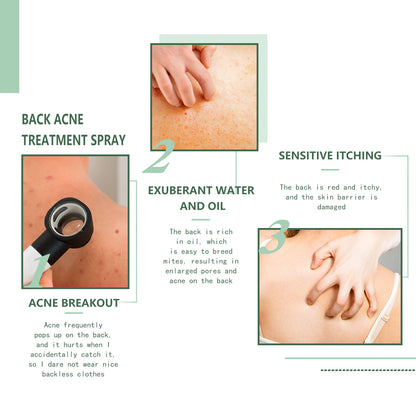 Back Acne Repair Back Shoulder Acne Desalination Acne Mark Skin Care Spray