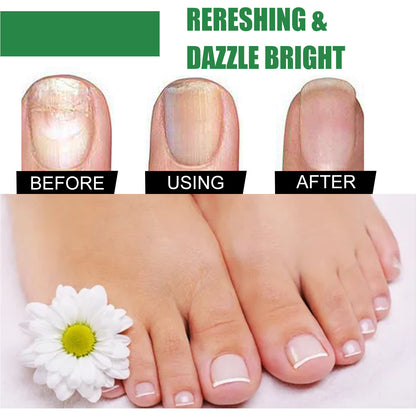 Foot Nail Tea Tree Oil Finger Thick Soft Nail Nutrition Hand And Foot Nail Care Solution