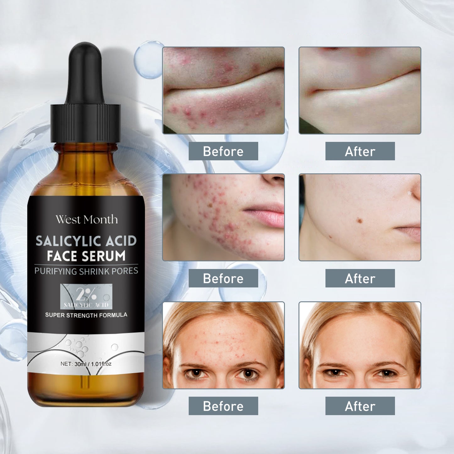West Month Salicylic Acid Facial Essence, Lighten Acne Mark Repair Hydrating Facial Care Essence