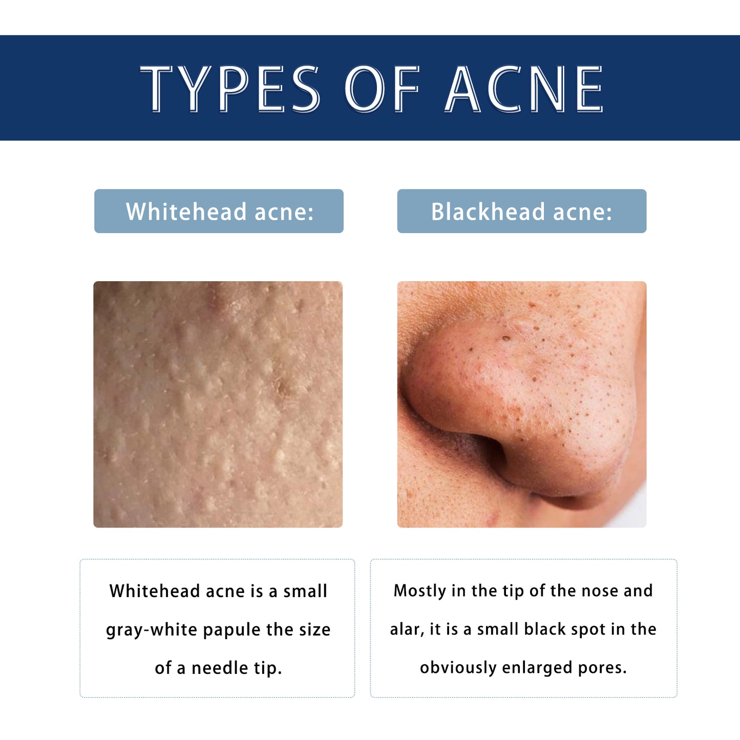 Hoygi Anti-Pimple Drying Lotion, Facial Cleansing And Repair Lighten Acne Marks And Pits, Close Your Mouth And Mild Skin Cream