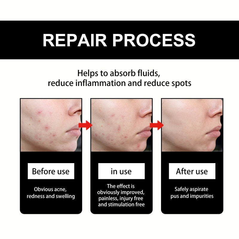 Cute Black Acne Cover Patch Reduces Spots