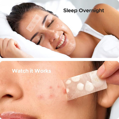 Acne Cover Patch Mild Desalting PIMPLE Acne Closed Mouth